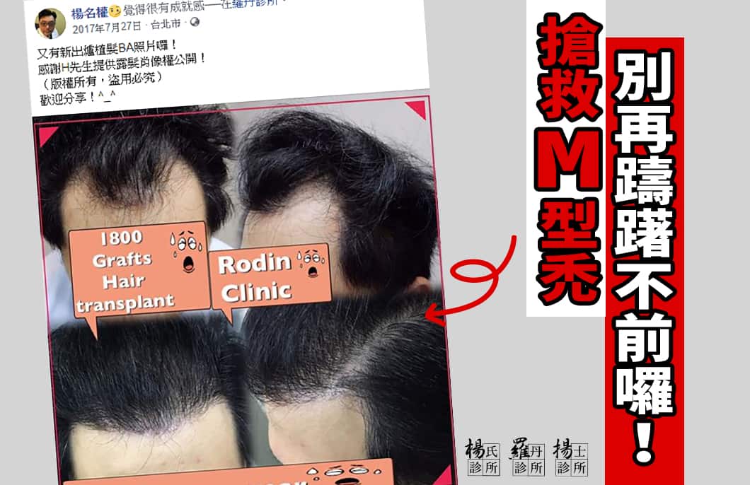 【植髮】搶救M型禿，別再躊躇不前囉！
